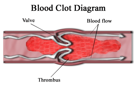 Understanding Clinton’s Blood Clot