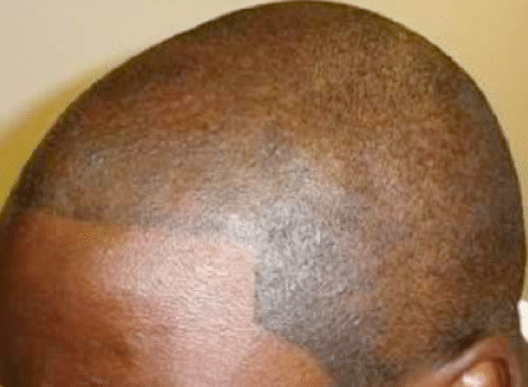 Ways to hide baldness